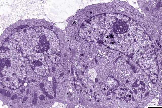 Liver cancer cells under the microscope. Picture: Hemedia/ SWNS